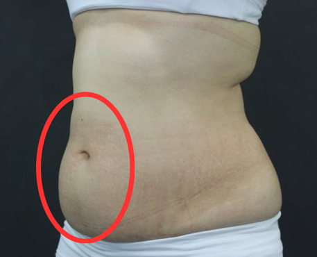 Before - 30代女性 4回