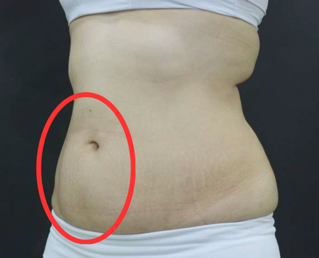 After - 30代女性 4回