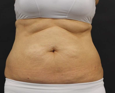 Before - 50代女性 9回