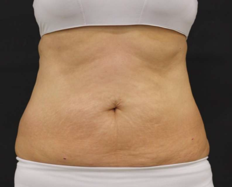 After - 50代女性 9回