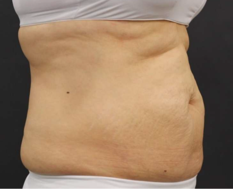 Before - 30代女性 12回