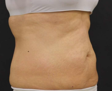 After - 30代女性 12回